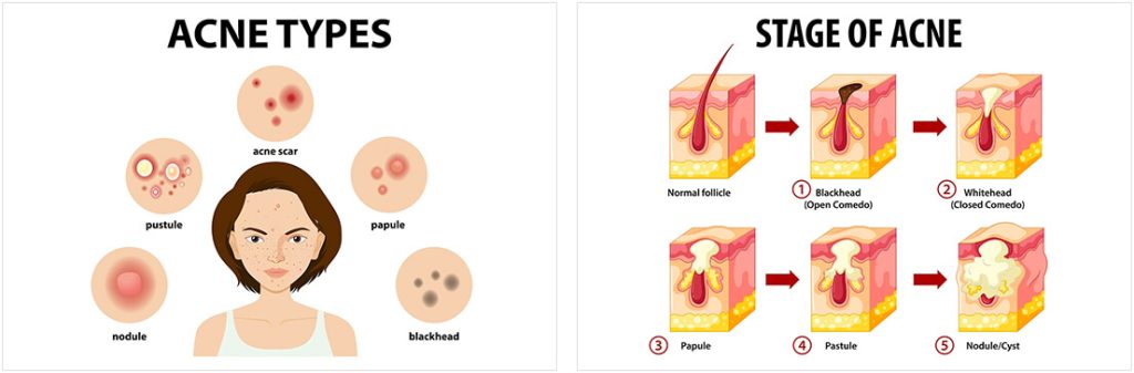 Pimples and pimple marks